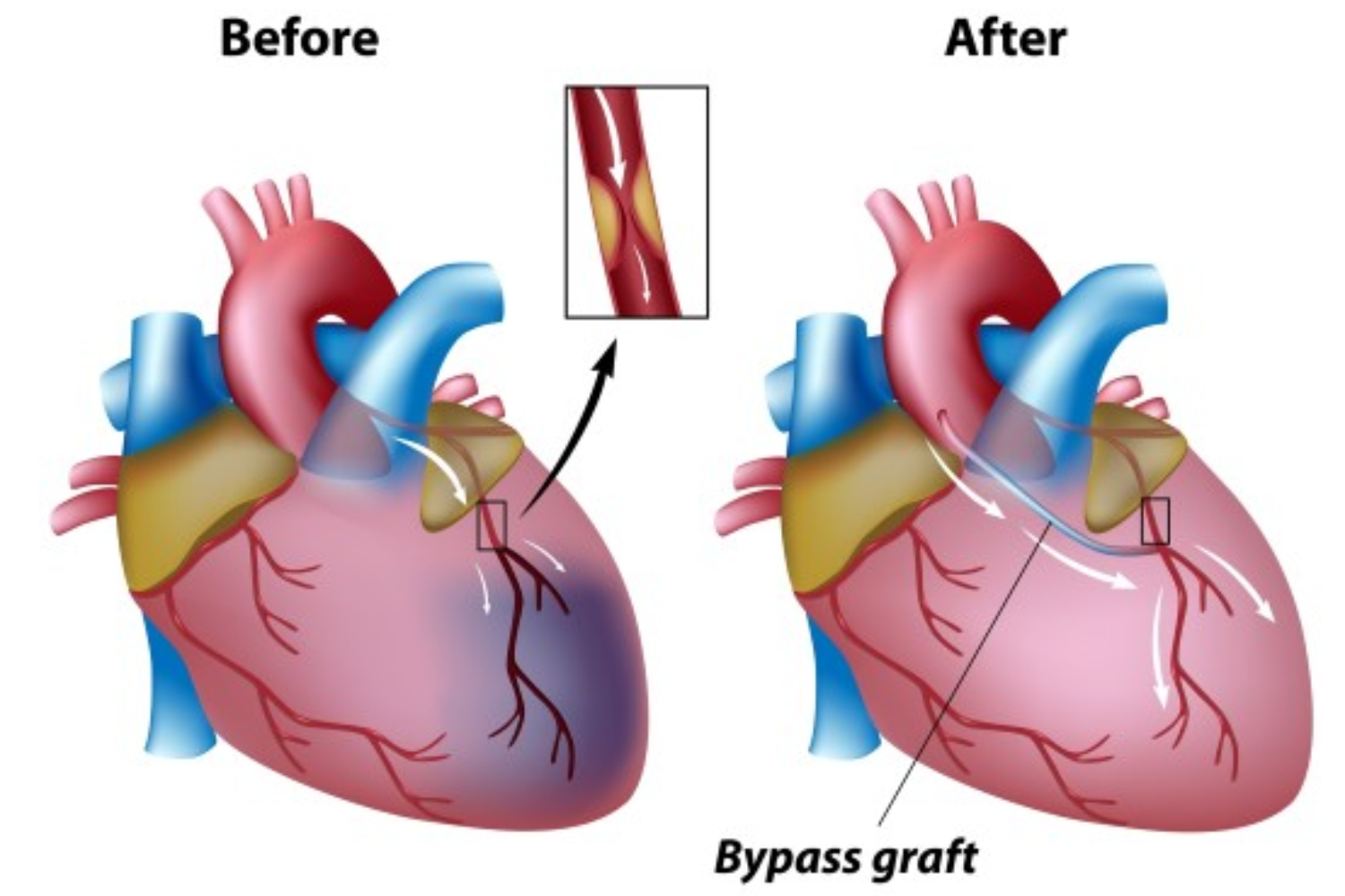 Heart Bypass Diagram