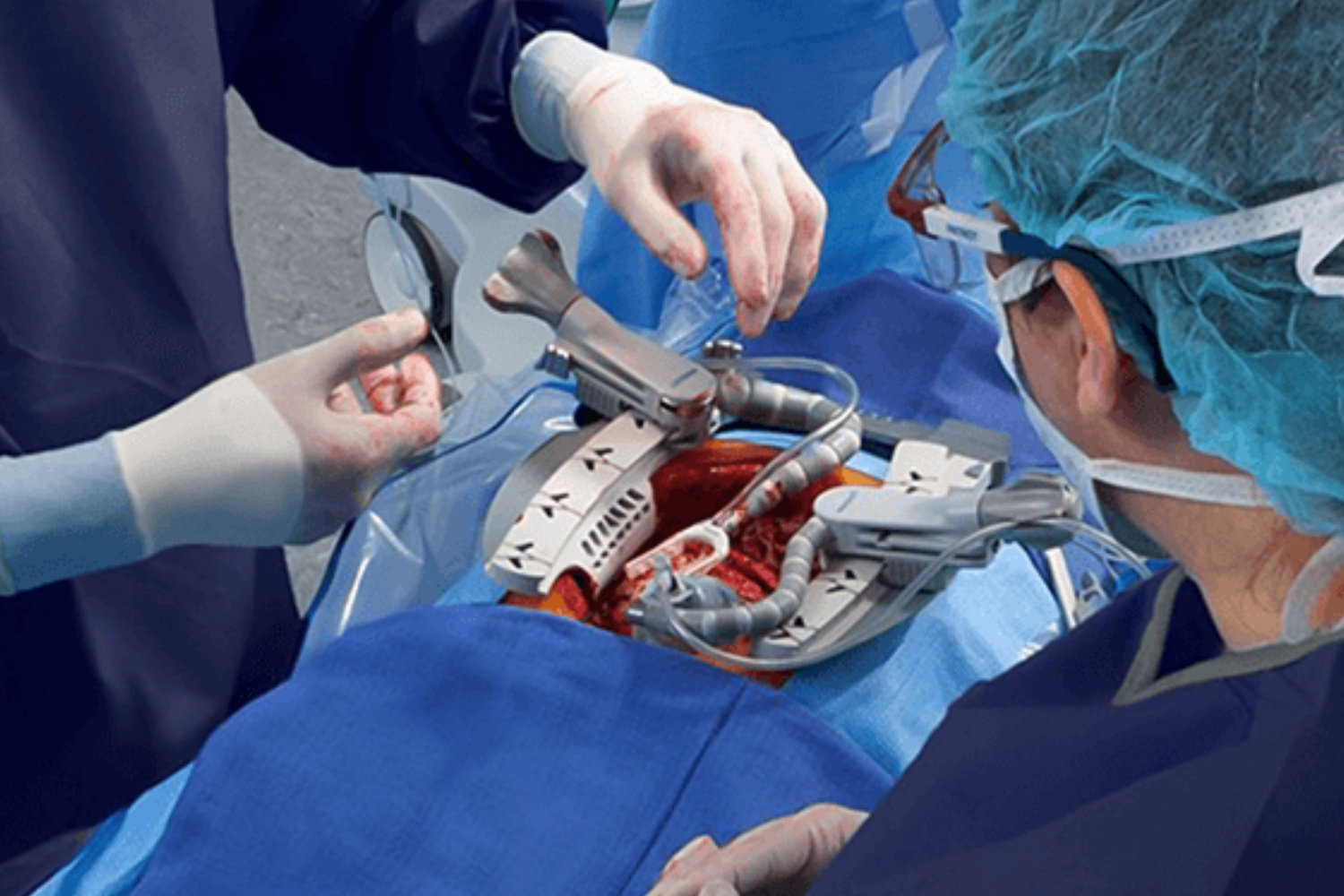 CABG Procedure Steps