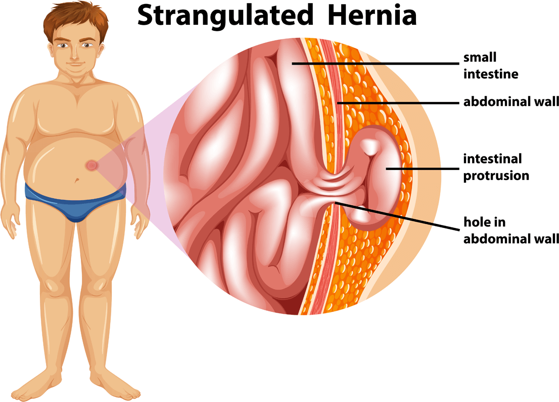 Strangulated Hernia